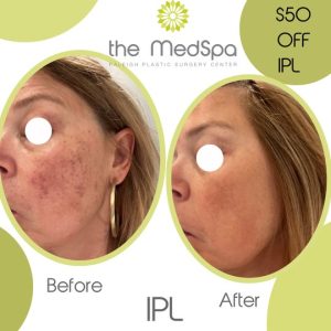 The MedSpa Raleigh - Black Friday deals